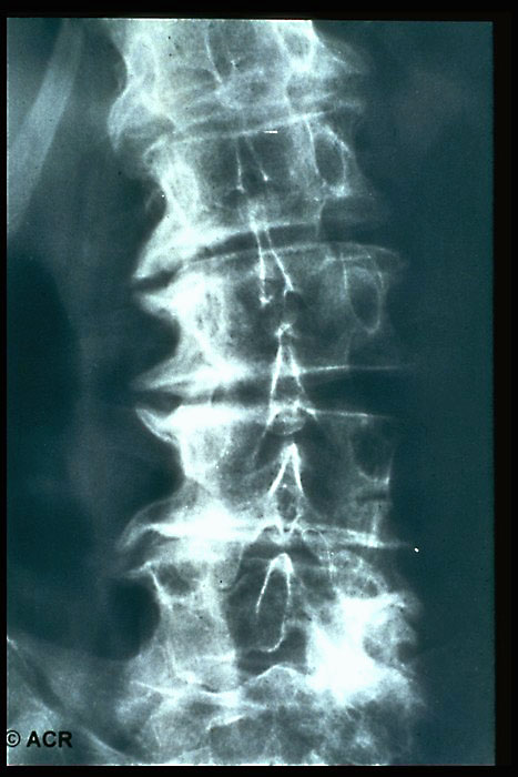 Спондилеза спондилоартроза поясничного отдела позвоночника. Спондилез шейного отдела рентген. Деформирующий спондилез рентген. Спондилёз поясничного отдела позвоночника ренгтен. Спондилёз поясничного отдела позвоночника рентген.